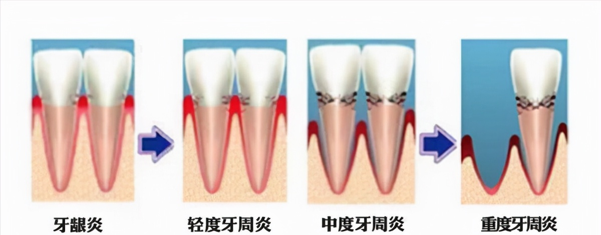 中度牙周炎图片