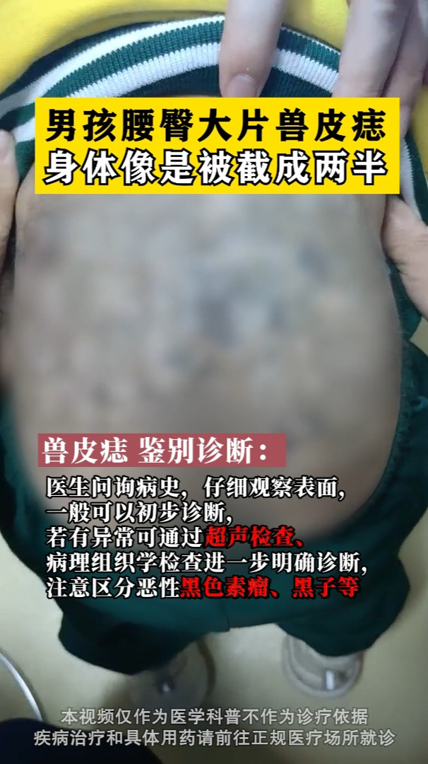 男孩腰臀大片兽皮痣,身体像是被截成两半