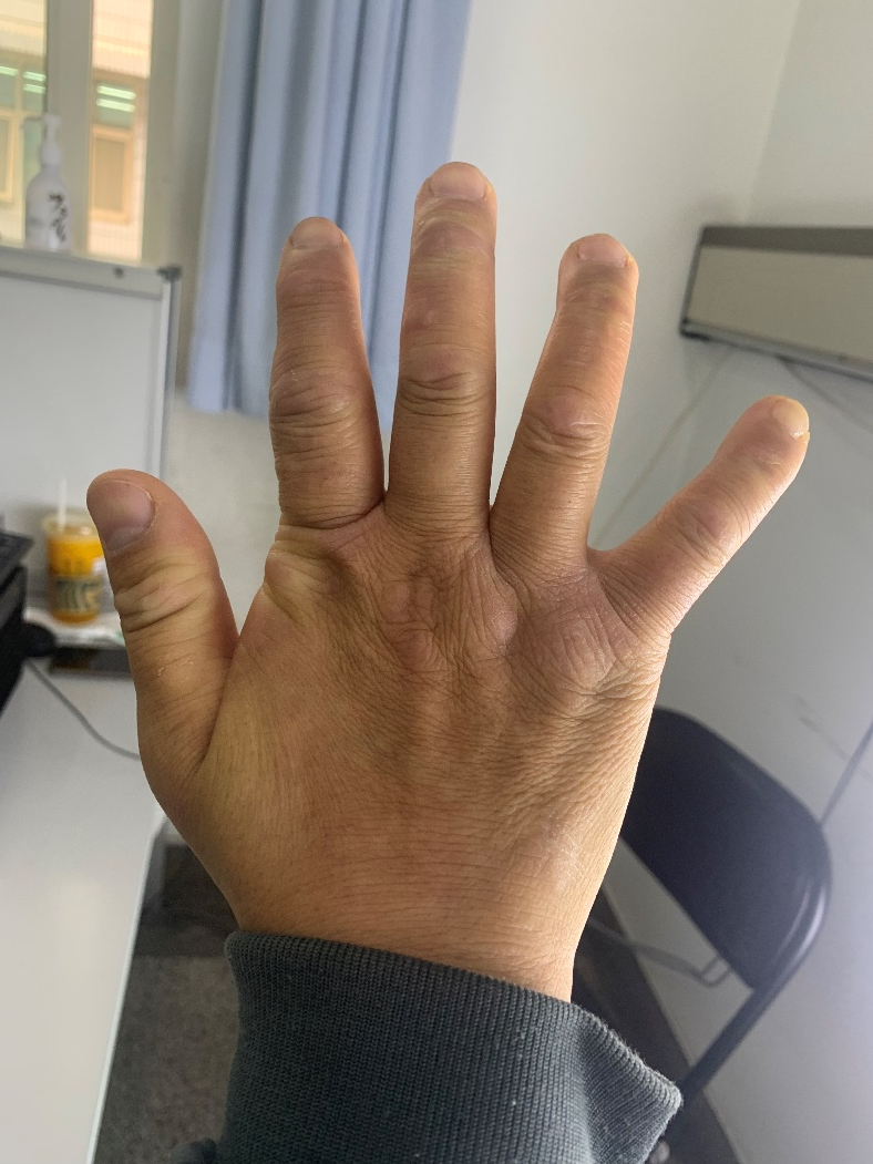 谢谢你,救回了"我"的手!——遇脊髓空洞症术后1年患者