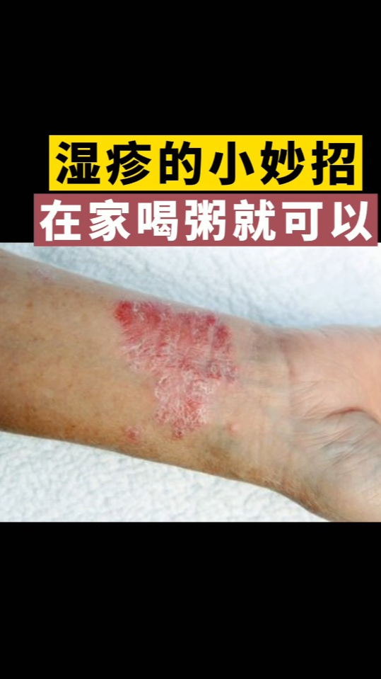身上湿疹瘙痒难忍忍不住的抓出流水送你一个方法