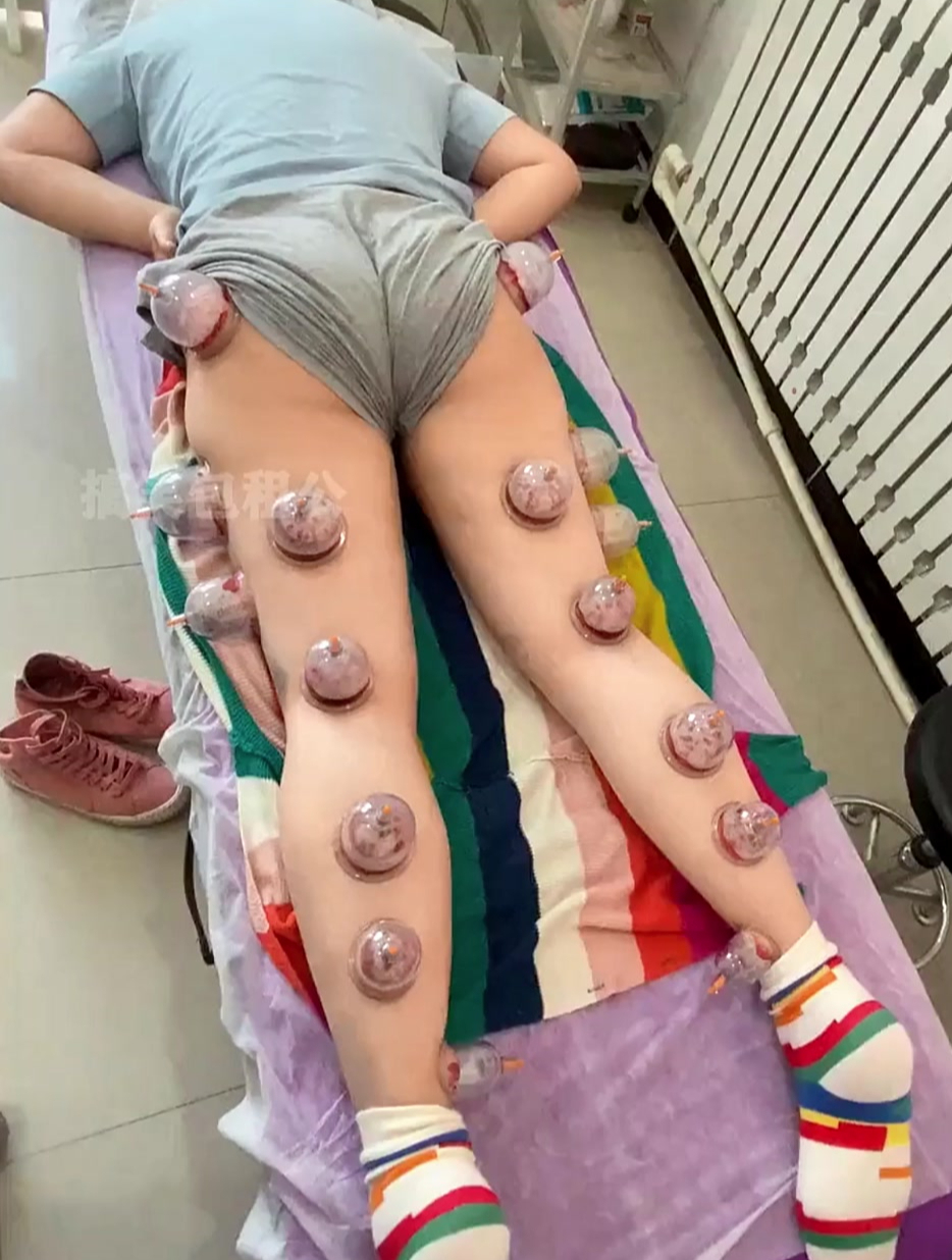 患有风湿病的美女去拔罐,没想到医生这么牛,直接给拔全腿!-度小视