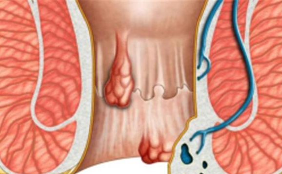 肛门摸到了小肉球,是痔疮还是尖锐湿疣呢?听听医生怎么说