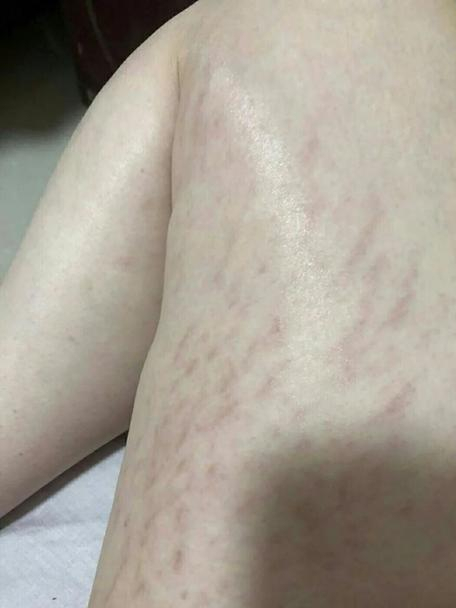 妊娠纹怎么处理呢?