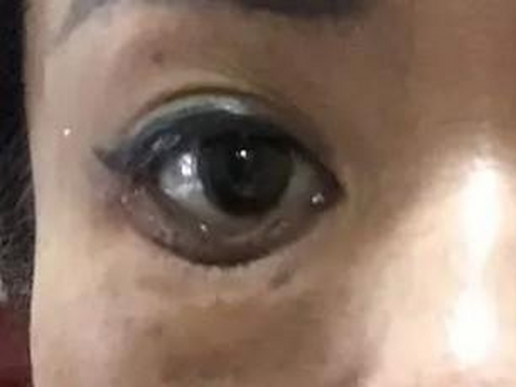 做个眼袋手术,把卧蚕给弄丢了这到底是怎么回事!