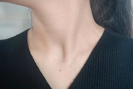 露肤季来了,甲亢粗脖挡不住该怎么办?学会这招,高效抗甲!