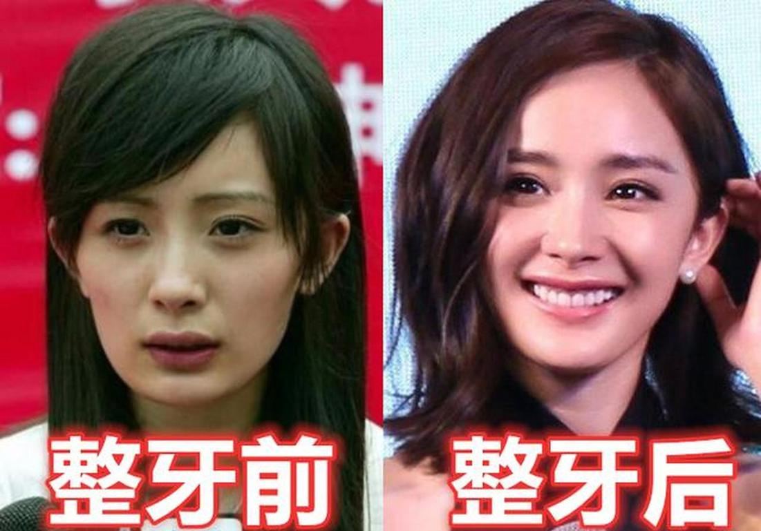 "整牙"如换头的5位明星:杨幂,baby秒变脸,胡歌颜值变化大