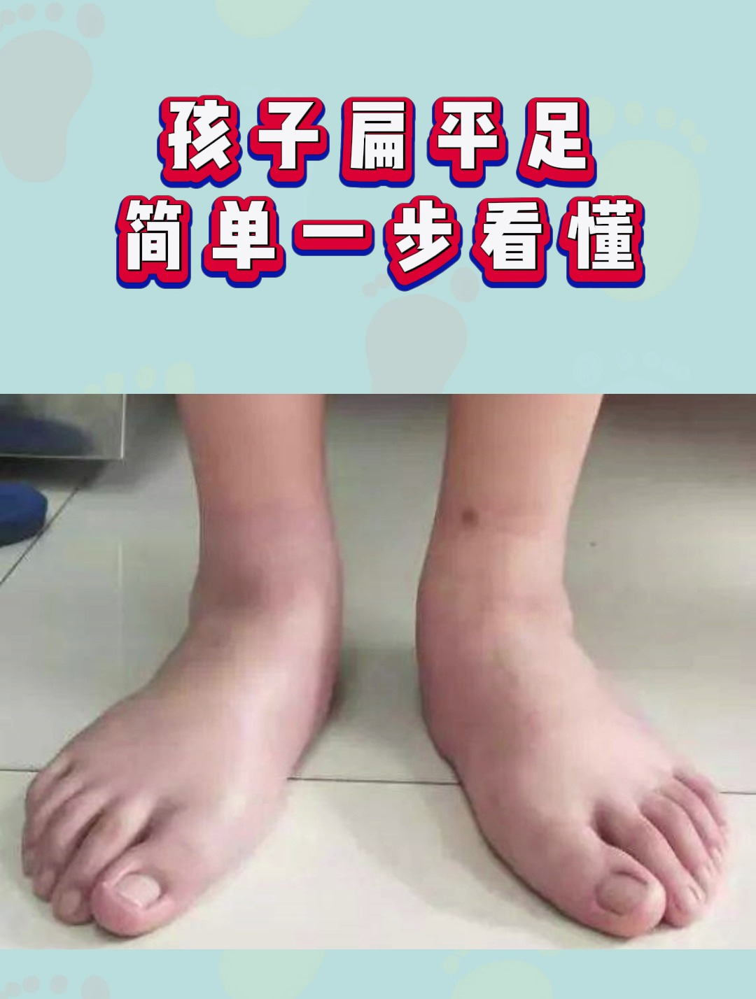 孩子扁平足简单一步看懂