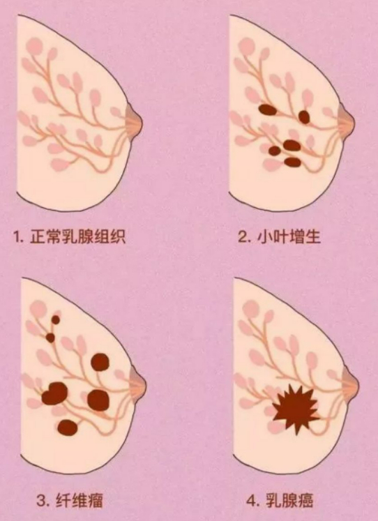 乳腺结节照片图片