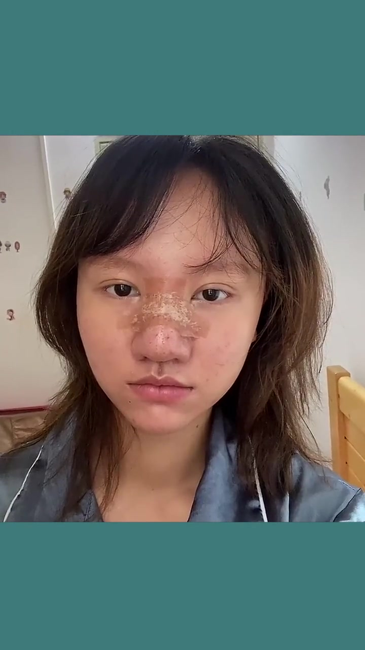 被朋友骗去整容,鼻子感染变成这样,人生还有希望吗?