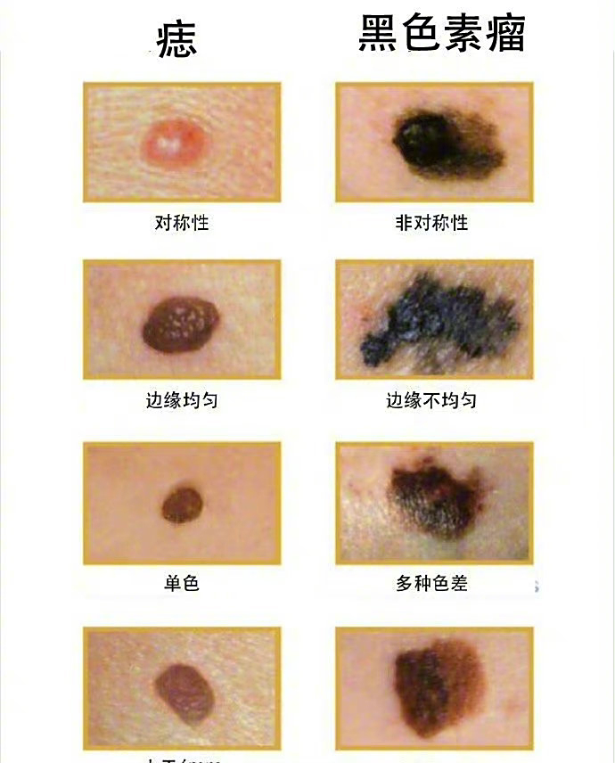 会癌变的黑色素瘤到底是什么?