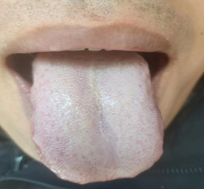 看舌象知健康!头晕,口干,口臭,教你1招,有效祛除痰湿