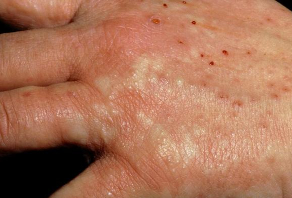 四弯风(肘窝,腘窝处湿疹)可不是普通的湿疹!从小就得!