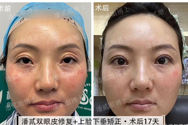 凸眼睛·潘贰双眼皮修复 上睑下垂矫正·术后17天