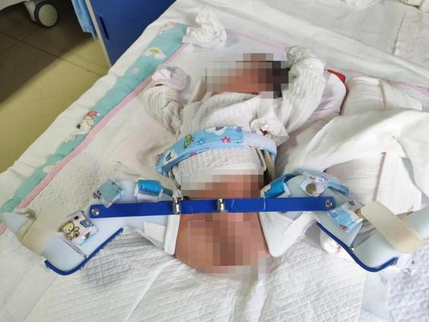 剖宫产时孩子大腿被主刀医生掰骨折?