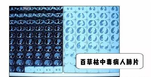 回顾:妻子用百草枯给丈夫洗内裤,导致丈夫下体溃烂,结局如何?
