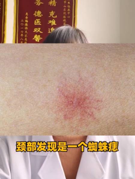 因为一颗蜘蛛痣怀疑自己是肝癌吓得一晚上没睡着