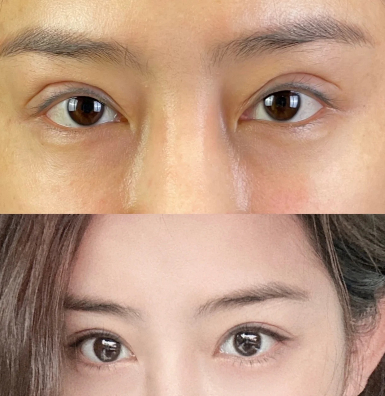 【双眼皮修复1年变化】  修复前:双眼皮假宽深,肉条感严重,线条不流畅