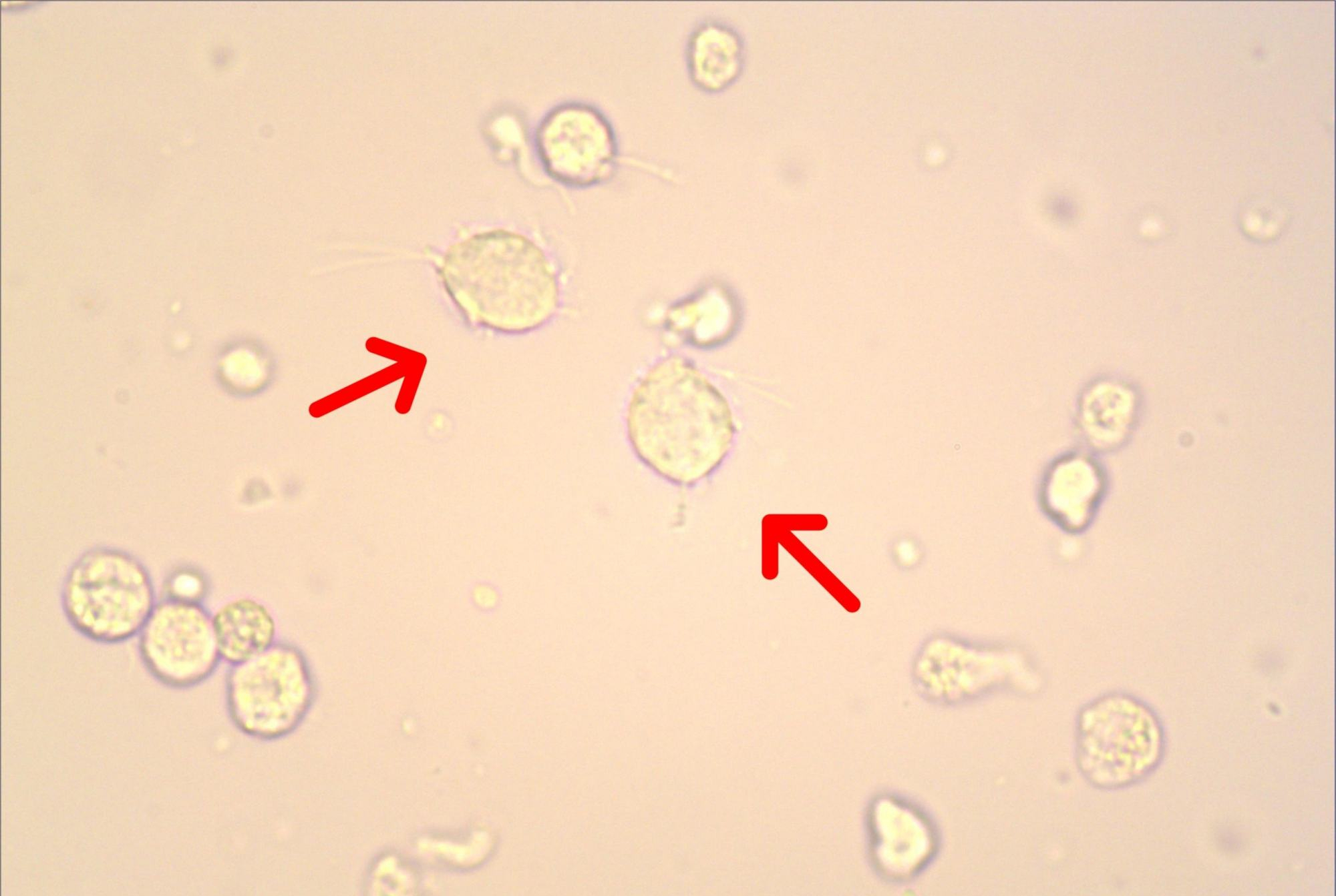 女性滴虫感染应当如何治疗