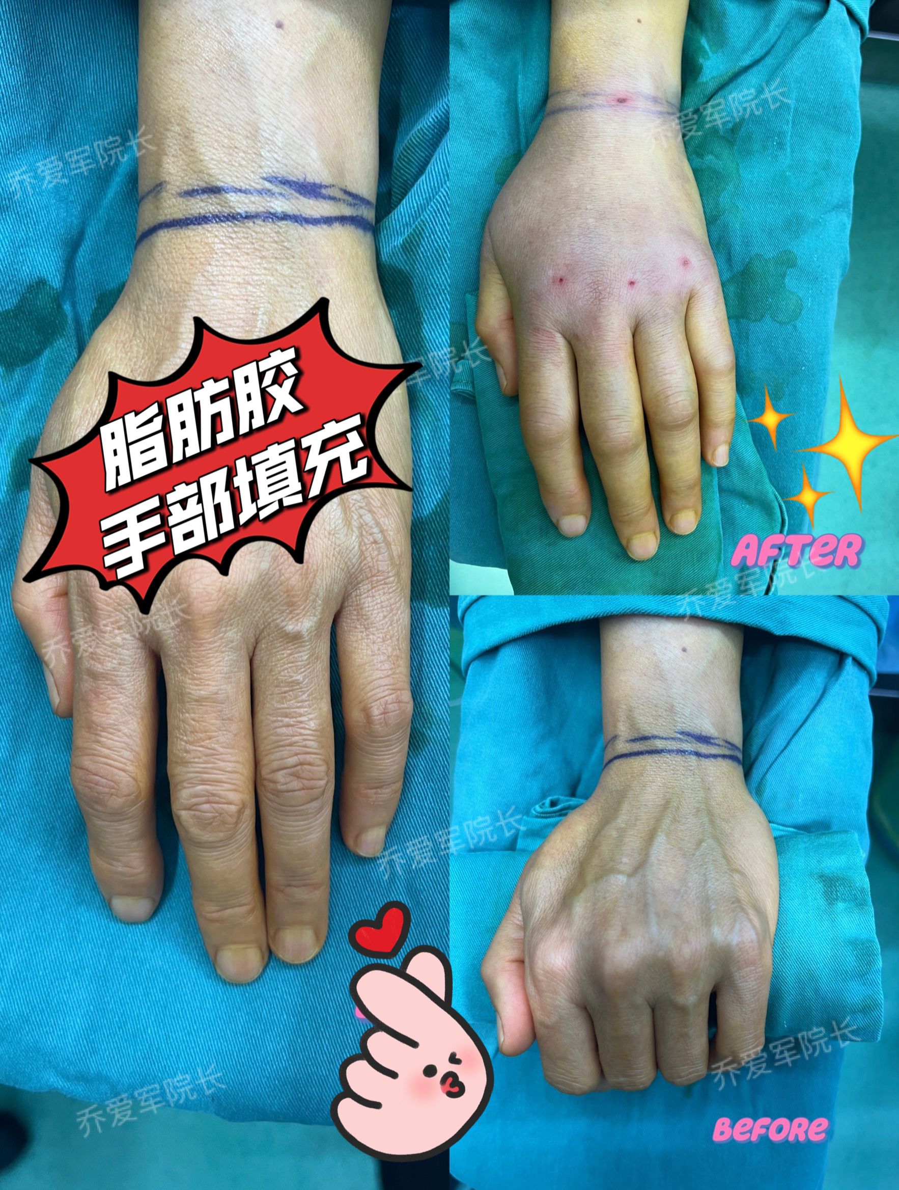 30岁的宝妈,50岁的手,脂肪胶手部填充,手术即刻效果状态~-度小视