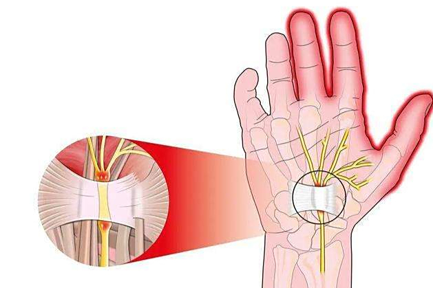 手指麻痛渐加重,小心腕管综合征,中医治疗方法是?
