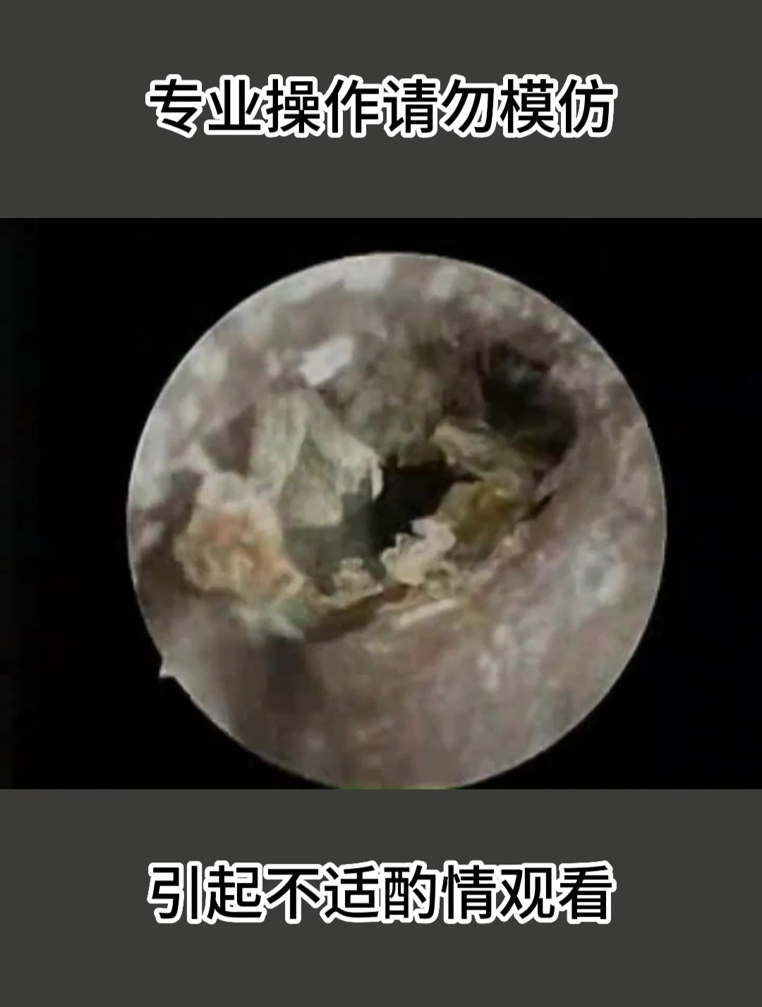 十年没掏过耳屎,挖出来的那一刻,我连饭都吃不下去了