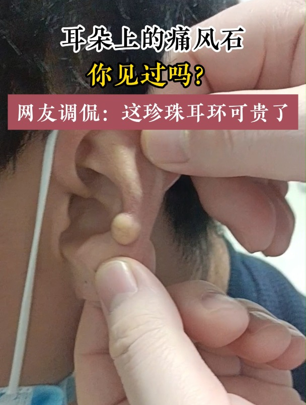 耳朵上的痛风石,你见过吗,网友调侃:这珍珠可贵了