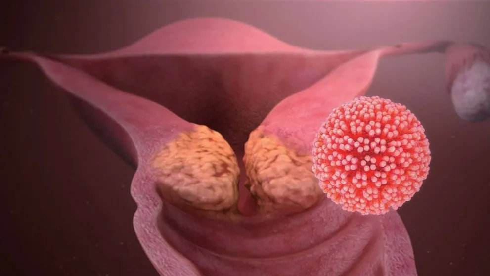 女性感染hpv后有症状吗?妇科医生:做这几项检查,或可尽早发现