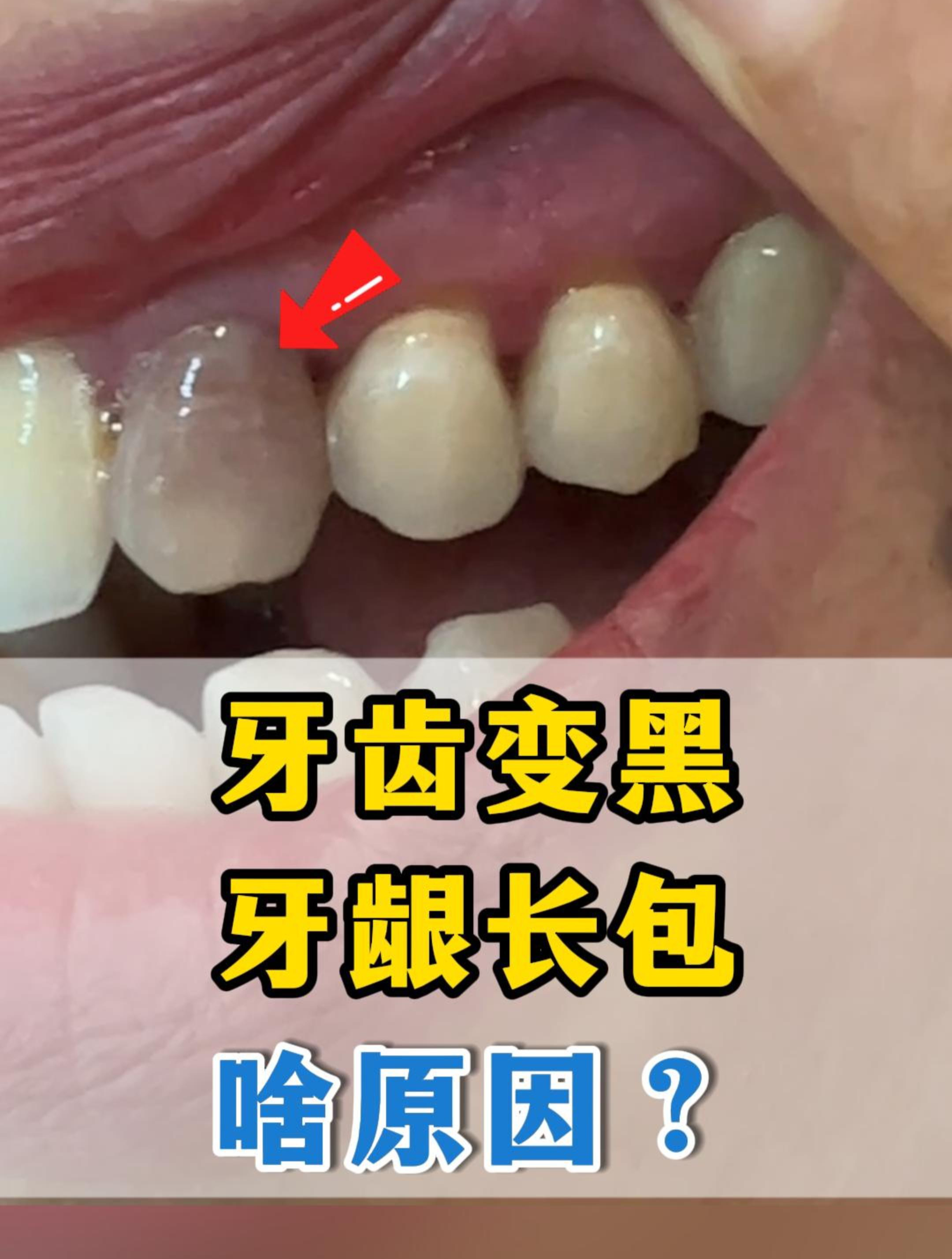 牙齿变黑很难看?可能是牙髓坏死!