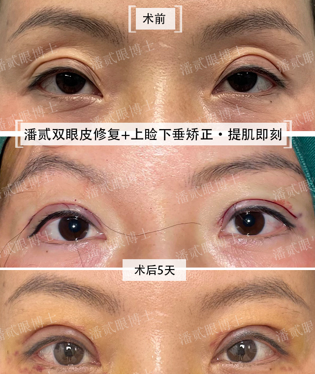 凸眼睛·潘贰双眼皮修复 上睑下垂矫正·术后5天