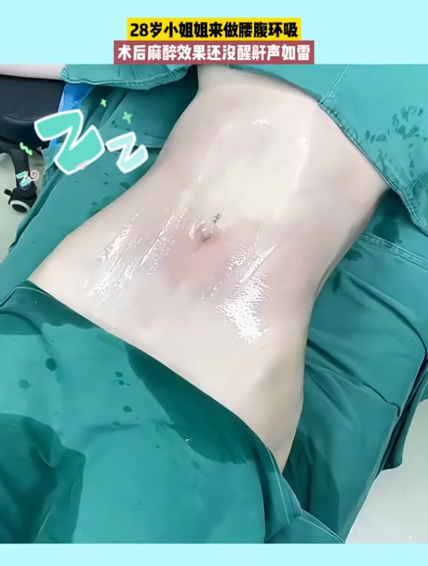 28岁小姐姐腰腹环吸 术后曲线玲珑有致-度小视