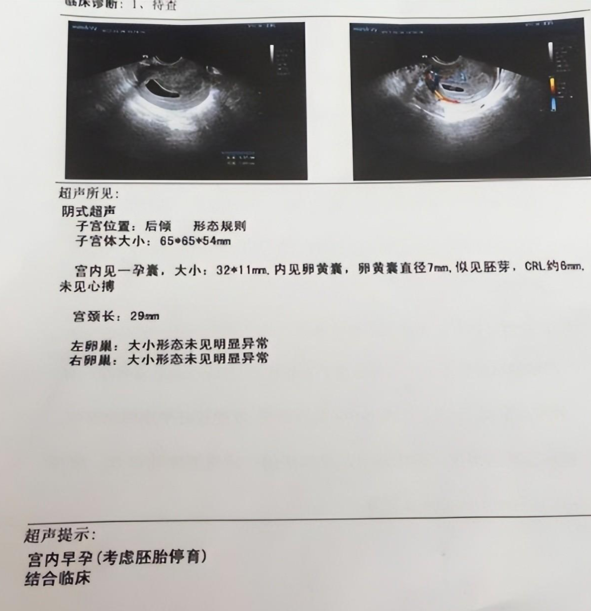 21年,黑龙江夫妻借22万做试管生下双胞胎,一年后意想不到事发生了