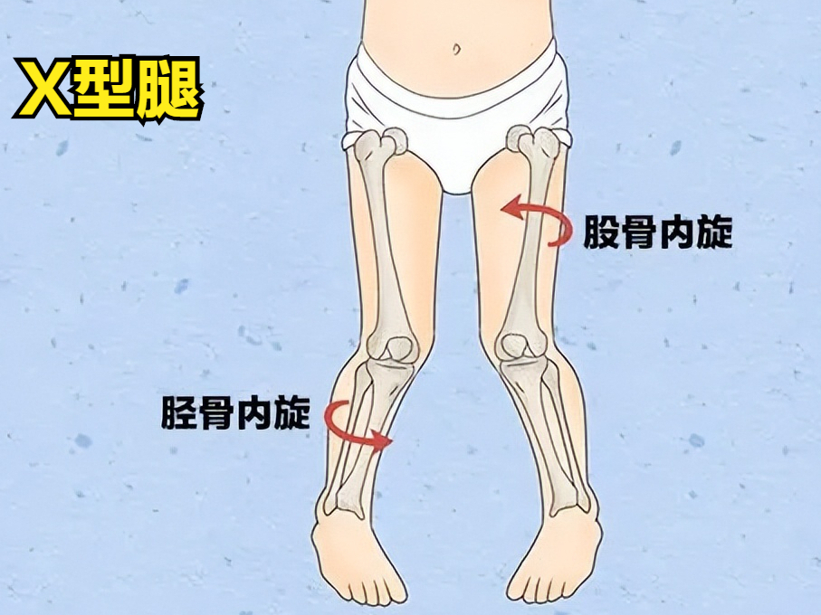 x型腿严重程度判断图图片