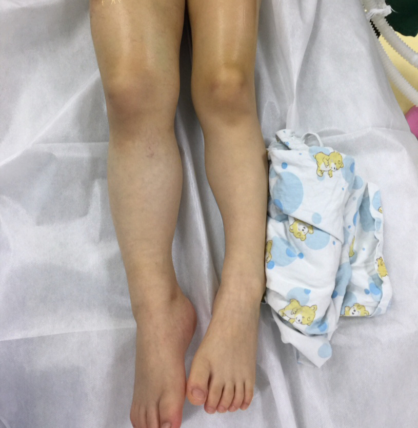 右下肢动静脉畸形(蔓状血管瘤,动静脉瘘)介入微创治疗病例