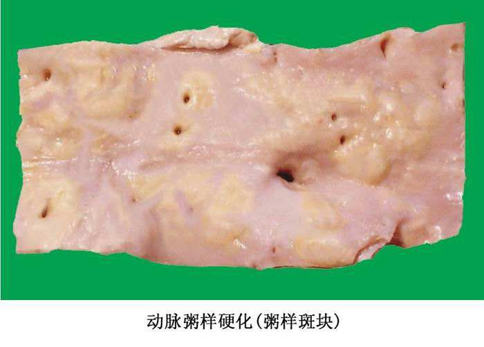 「一问一答」动脉粥样硬化斑块能不能逆转?