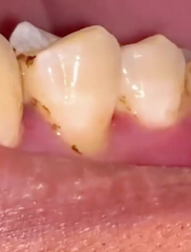 看小姐姐如何给别人洗牙,这么大的牙结石,洗下来是什么感觉!