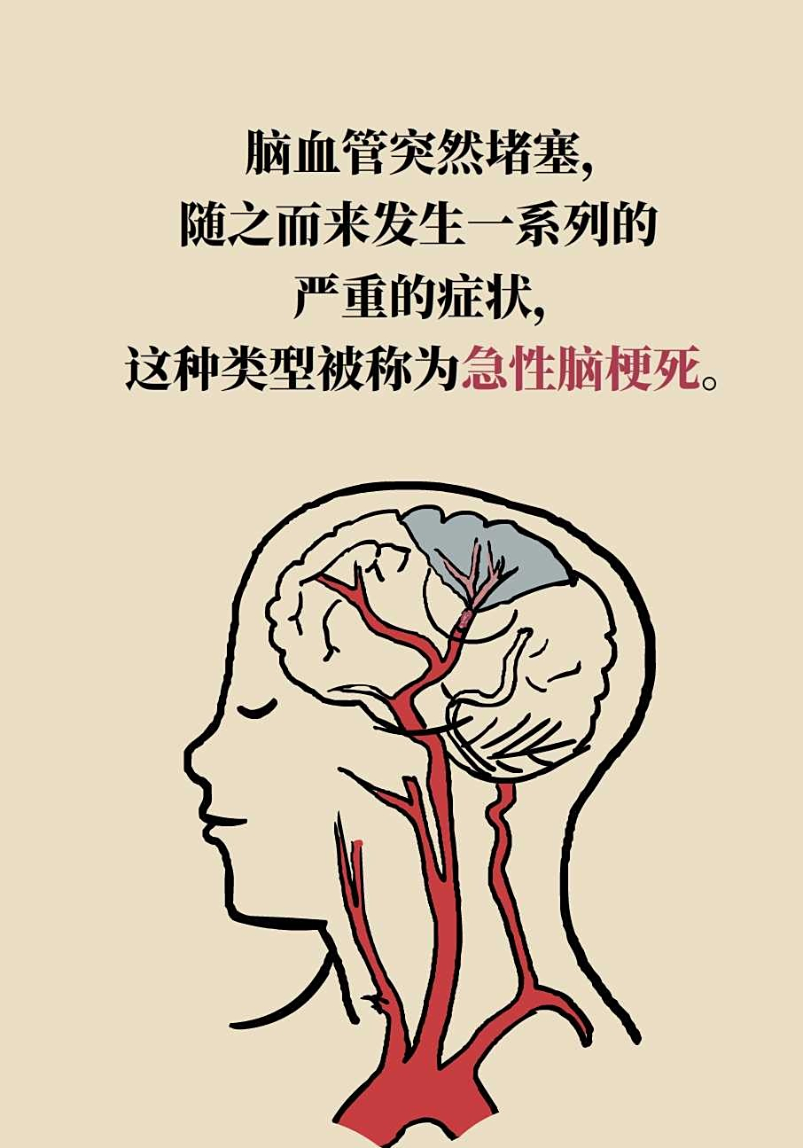 从而会使脑组织出现缺血缺氧和坏死,而脑出血往往是由于患者存在高
