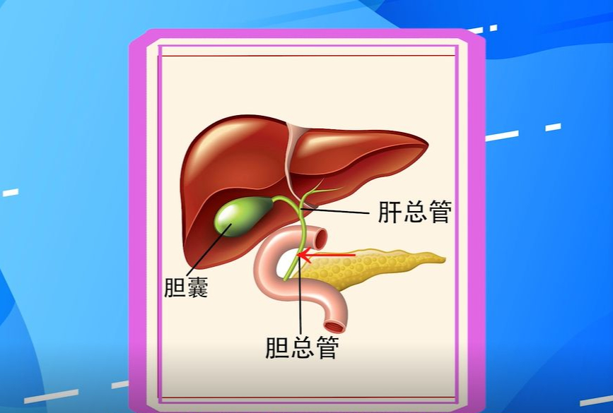 肝内胆管结石的症状