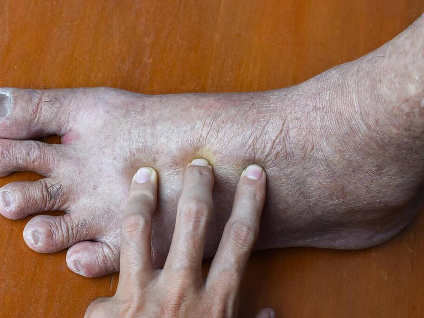 或是身体出问题了,别不在意  1,脚踝水肿  早晨起来脚踝水肿,在起床