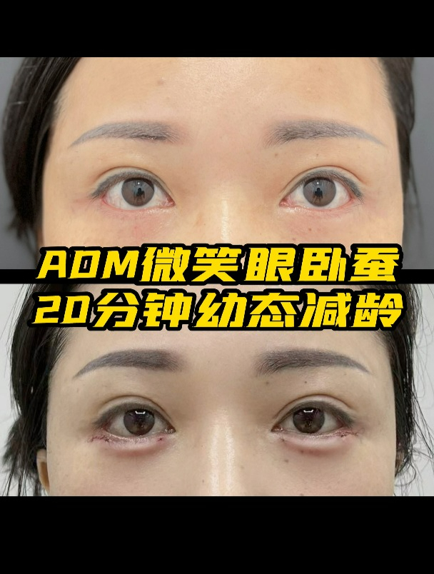 adm微笑眼卧蚕,20分钟幼态减龄