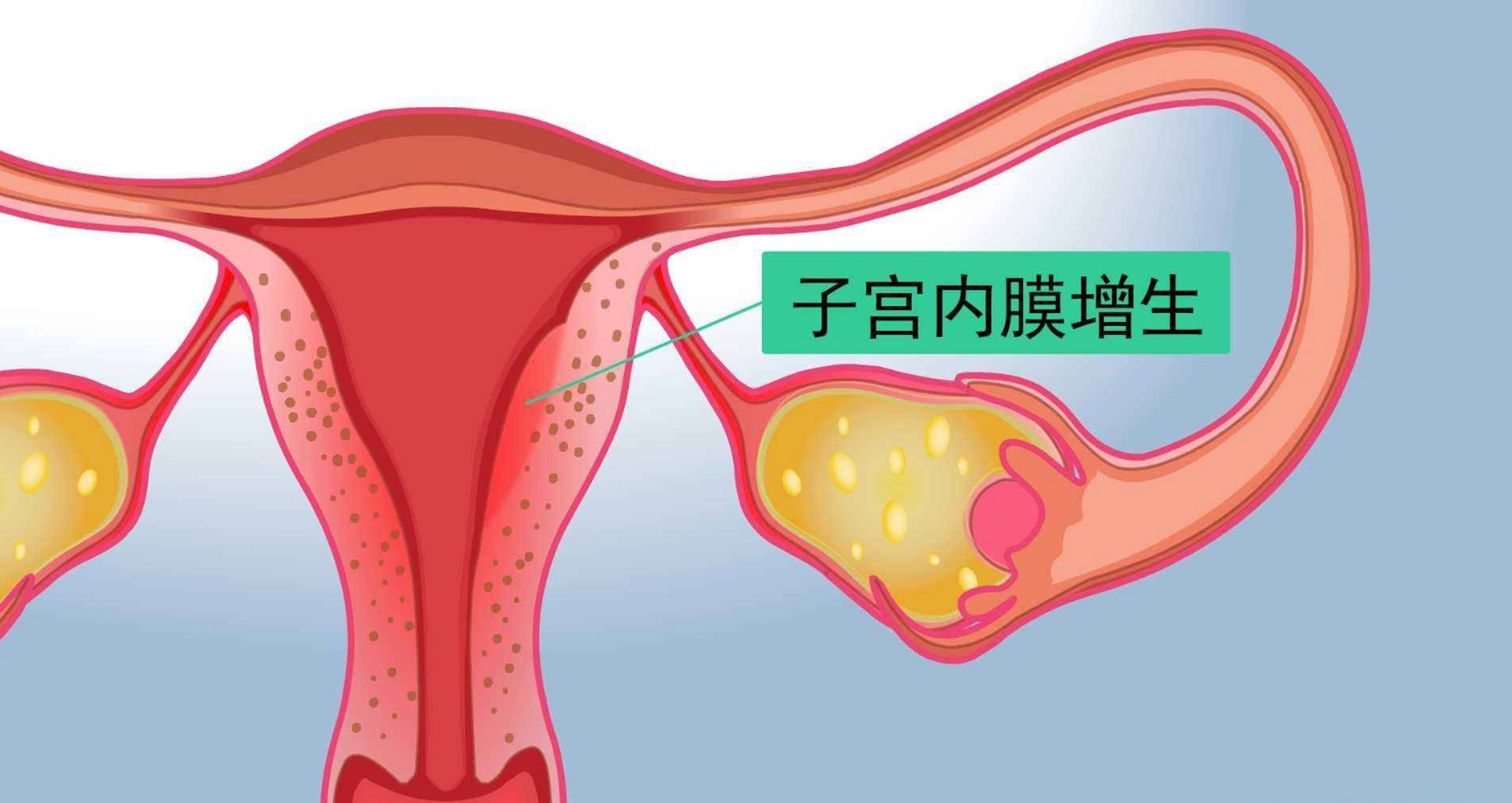 子宫内膜增厚 刮宫图片