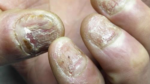 指甲泛黄增厚还掉渣!康复者治愈秘籍大公开,简单三招对症根除!