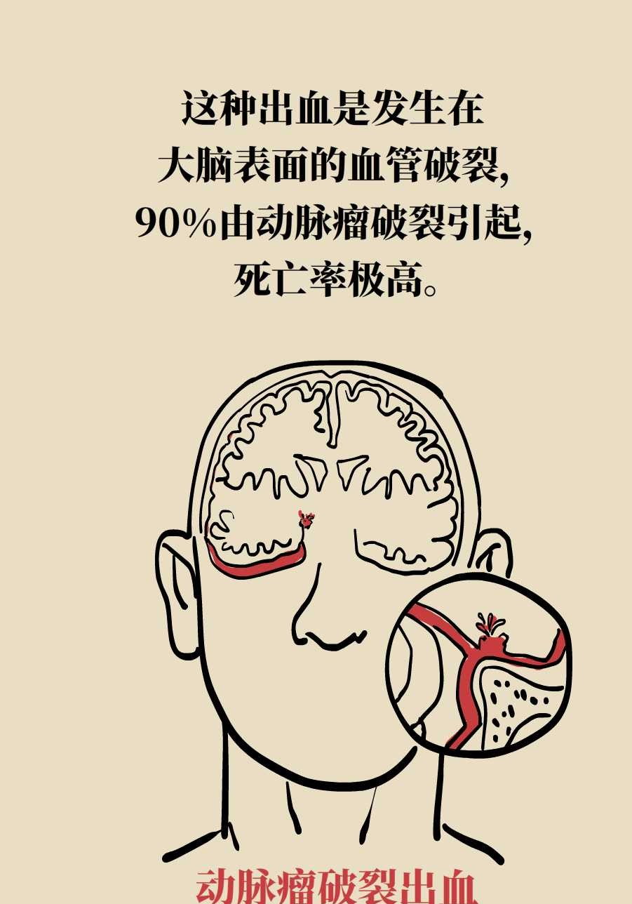 脑梗塞健康教育漫画图图片