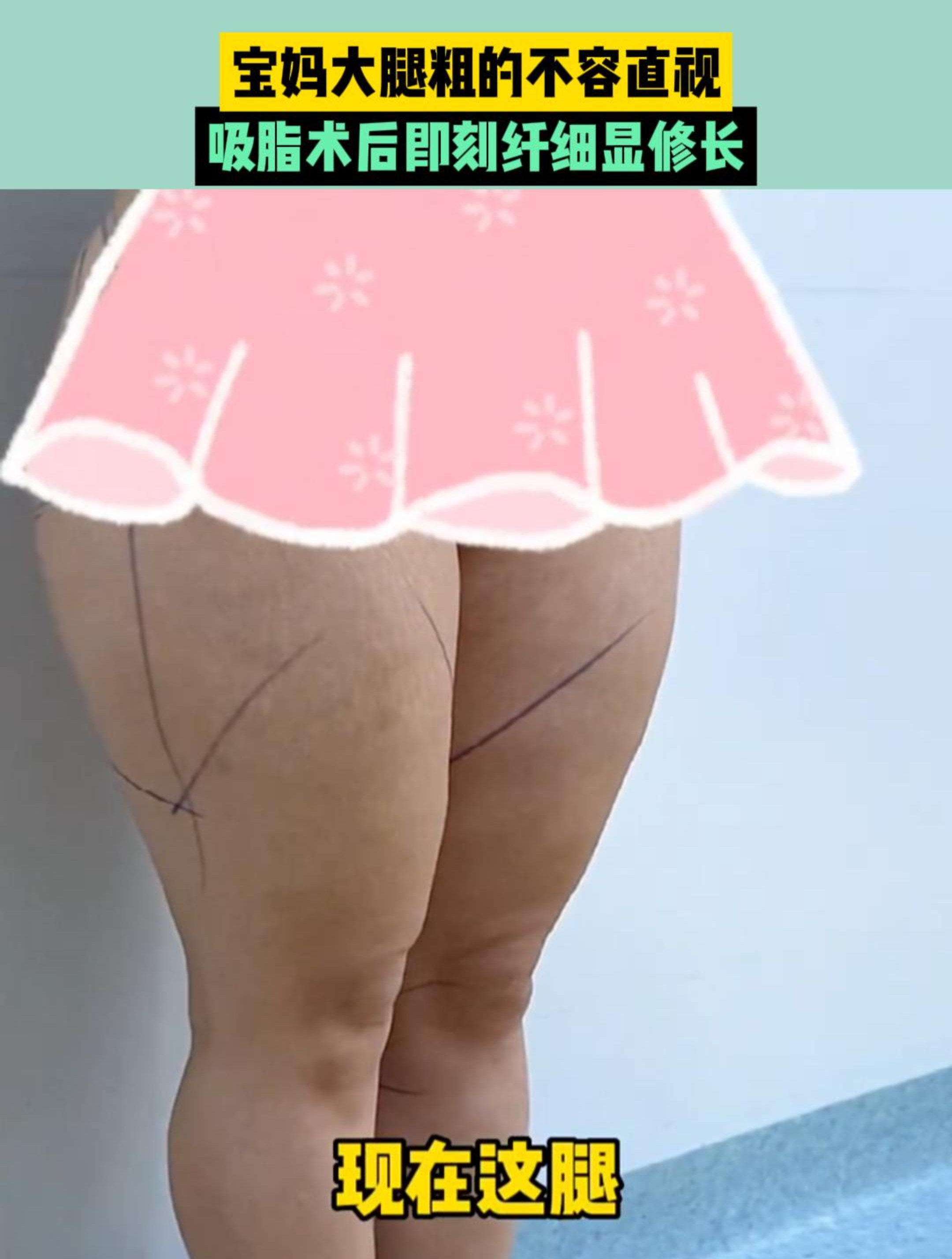 宝妈大腿粗的不容直视,吸脂术后即刻纤细显修长