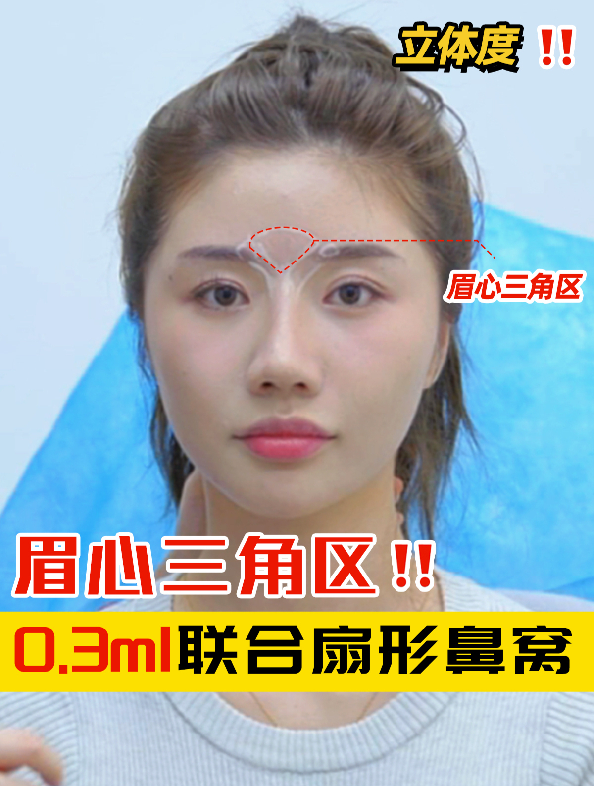 眉心三角区0.3ml联合扇形鼻窝塑造立体感