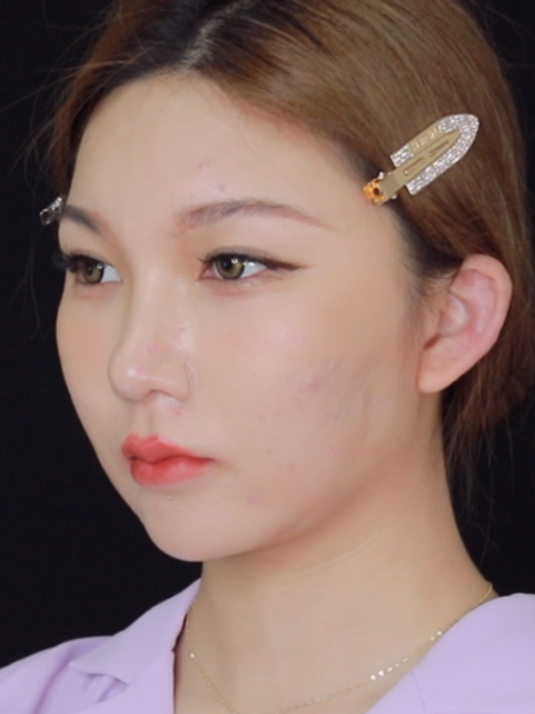 鼻修复 假体取出,打造自然小翘鼻