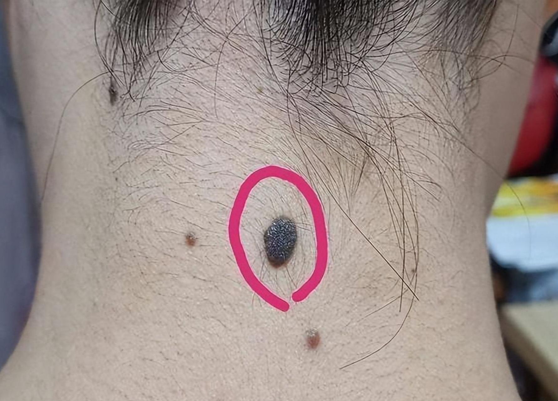 1,痣长得不太对称 2,痣的颜色不均匀的 3,痣的直径特别大(>0.