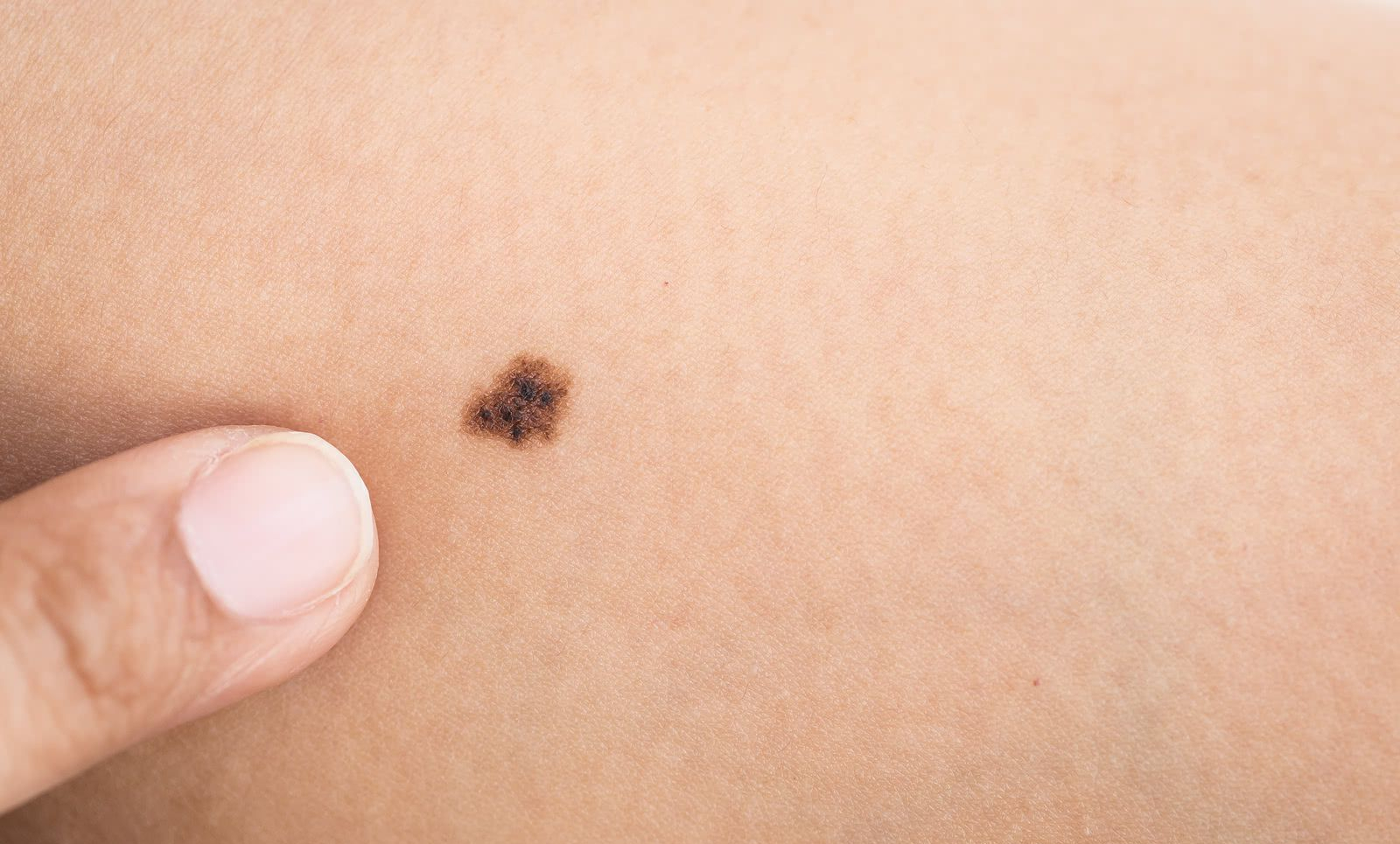 身上长的"痣",需要去除吗?激光vs手术,哪个比较好?