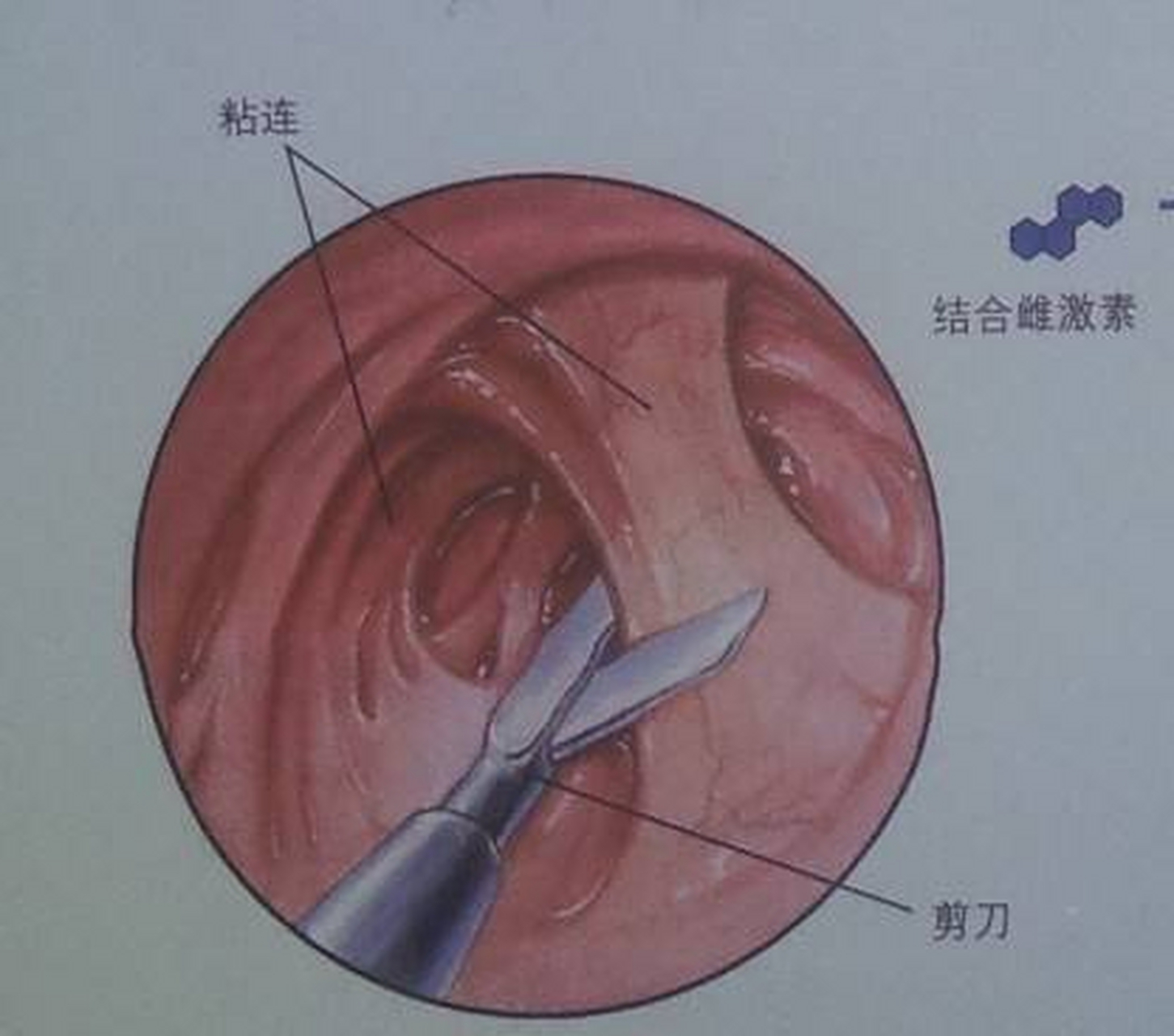 宫腔分离2mm图片