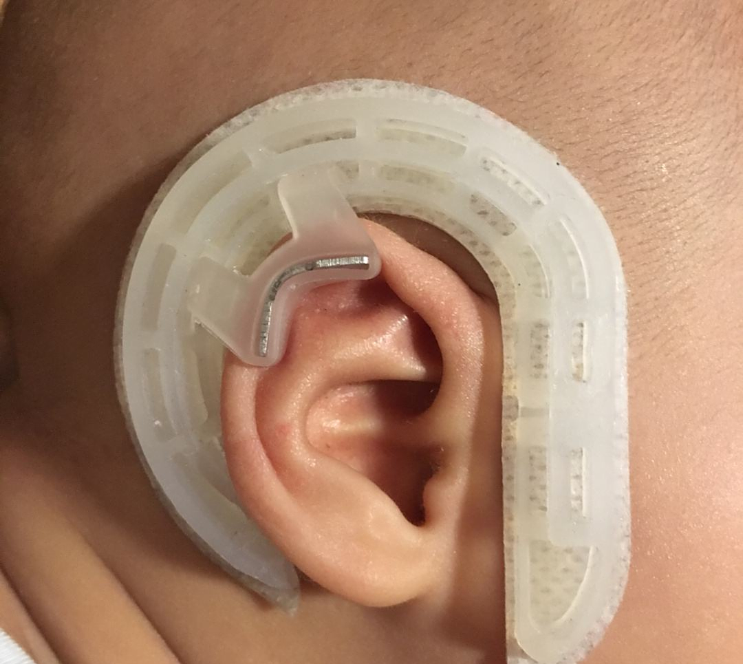 婴儿听力筛查没过怎么办,如果耳朵畸形应该怎么矫正