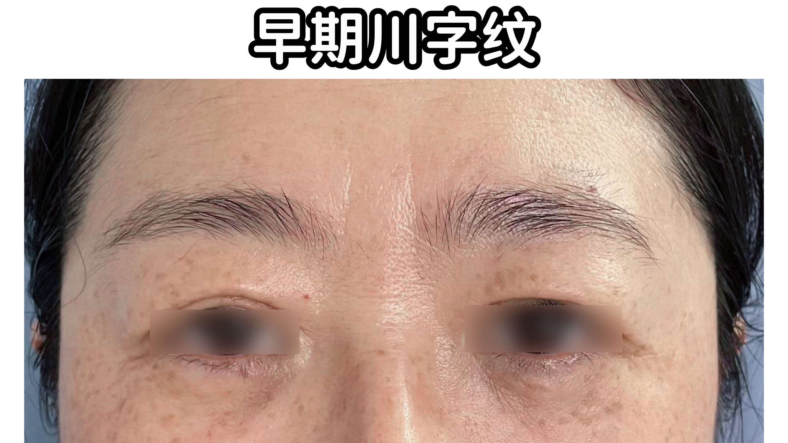 眉间川字纹发展成了这样?医生:再不重视,就只能挨一"刀"了